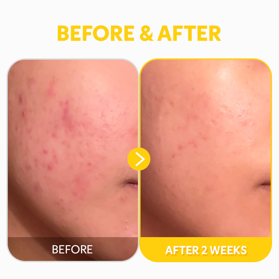 Comparativa antes y después de dos semanas de uso de serum de vitamina c24 tirtir: lado izquierdo con piel enrojecida y texturizada, lado derecho con piel más uniforme y menos rojeces.