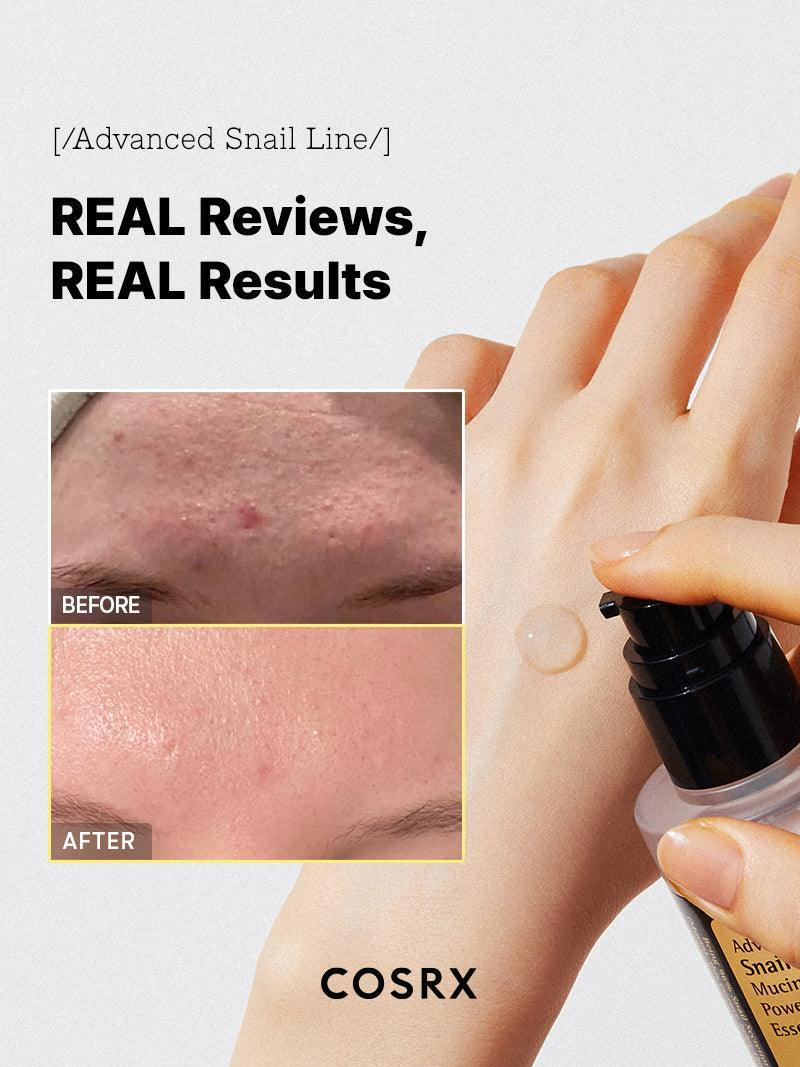Collage comparativo de piel facial antes y después de usar COSRX Advanced Snail 96 Mucin Power Essence, con mejoría en granos y enrojecimiento, acompañado de la botella dispensando el producto en la mano.