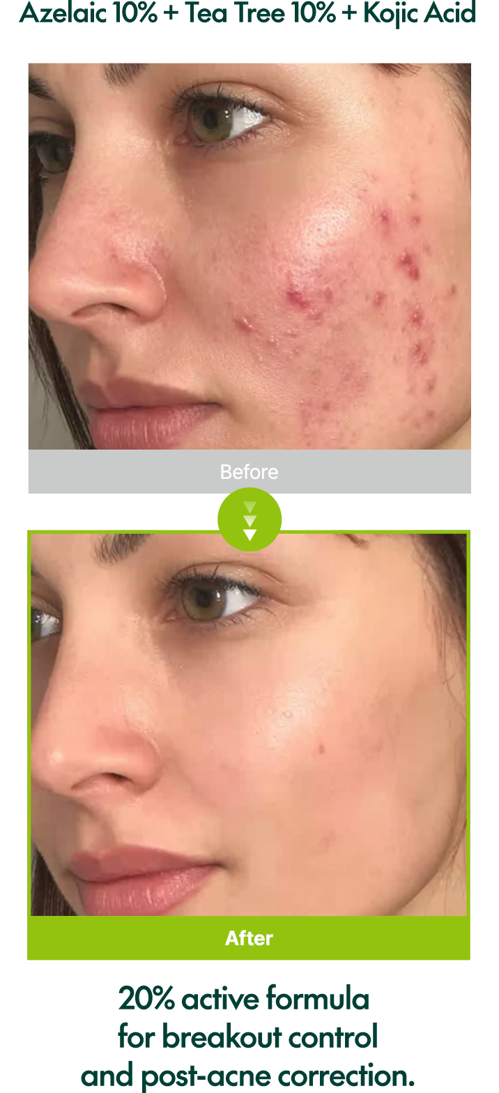 Comparación antes y después en primer plano del rostro de una mujer mostrando reducción de enrojecimiento e imperfecciones después del uso del Purito Azelaic Acid 10 Kojic Tea Tree Serum.