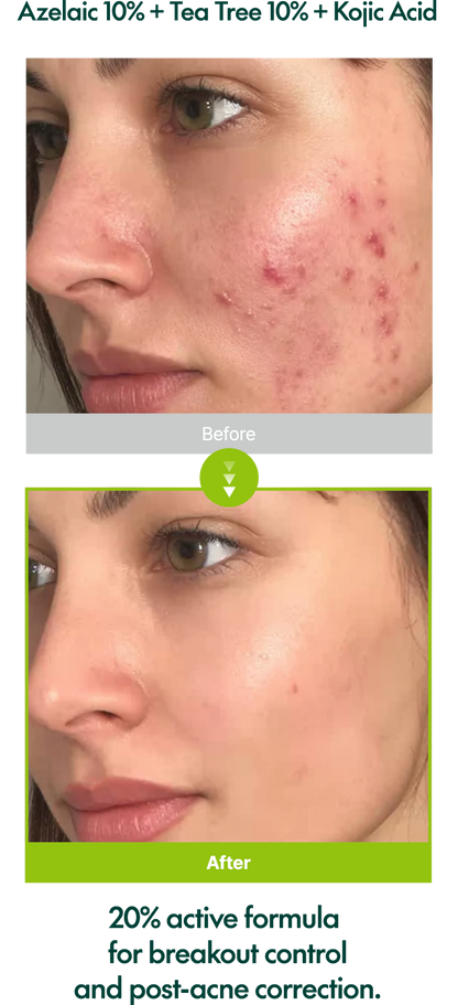 Comparación antes y después en primer plano del rostro de una mujer mostrando reducción de enrojecimiento e imperfecciones después del uso del Purito Azelaic Acid 10 Kojic Tea Tree Serum.